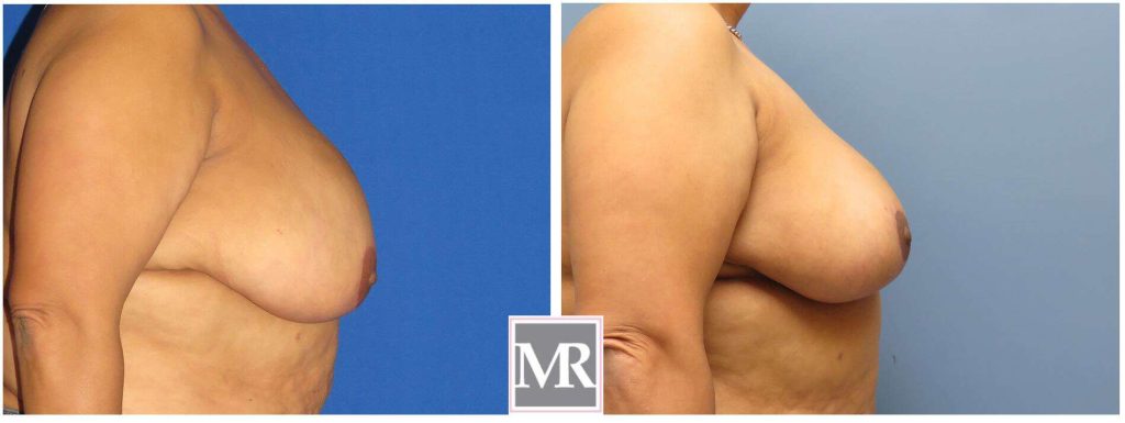 Breast Reduction before after CA