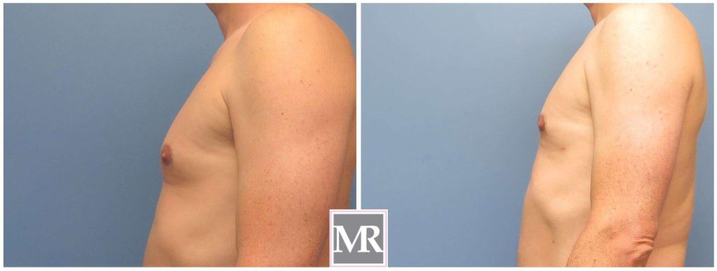 Gynecomastia before after pics Beverly Hills