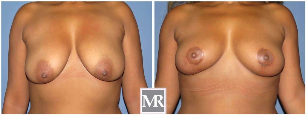 Mastopexy Breast Lift before after pics 90210