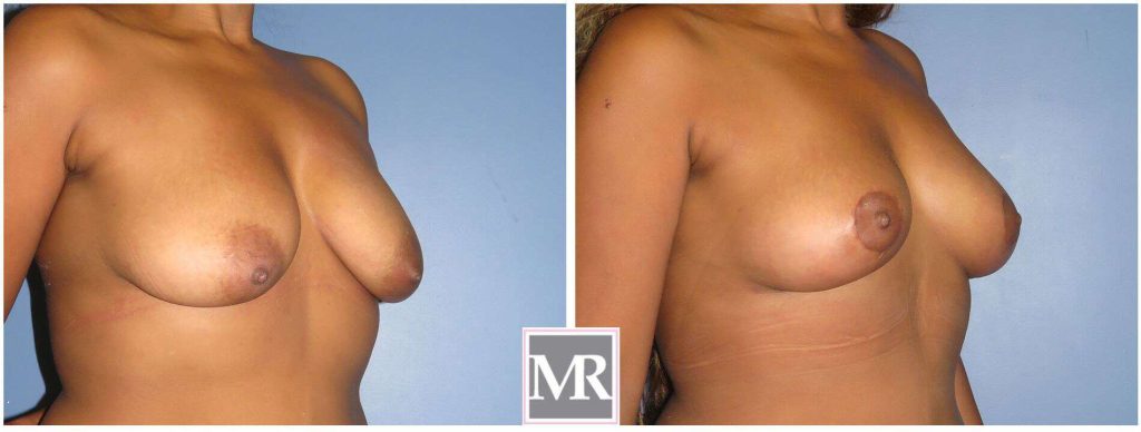 Mastopexy Breast Lift after results pics