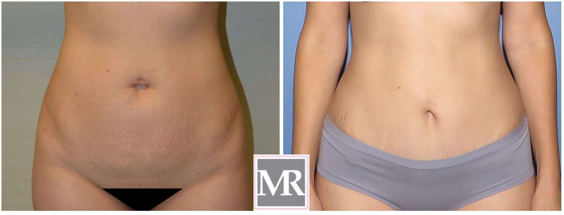 Mini-Tummy Tuck Before and After Beverly Hills - Millicent Rovelo MD