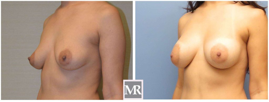Breast Implants view the results