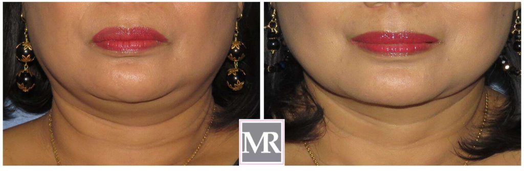 Neck Liposuction before after results