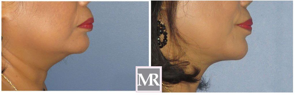 Neck Liposuction before after pics