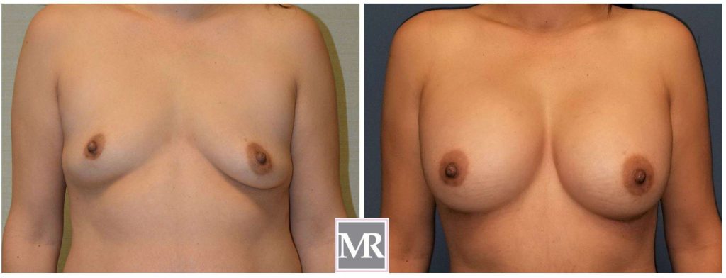 Breast Implants view pics Beverly Hills