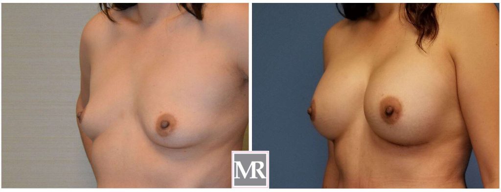 best Breast Implant results pics
