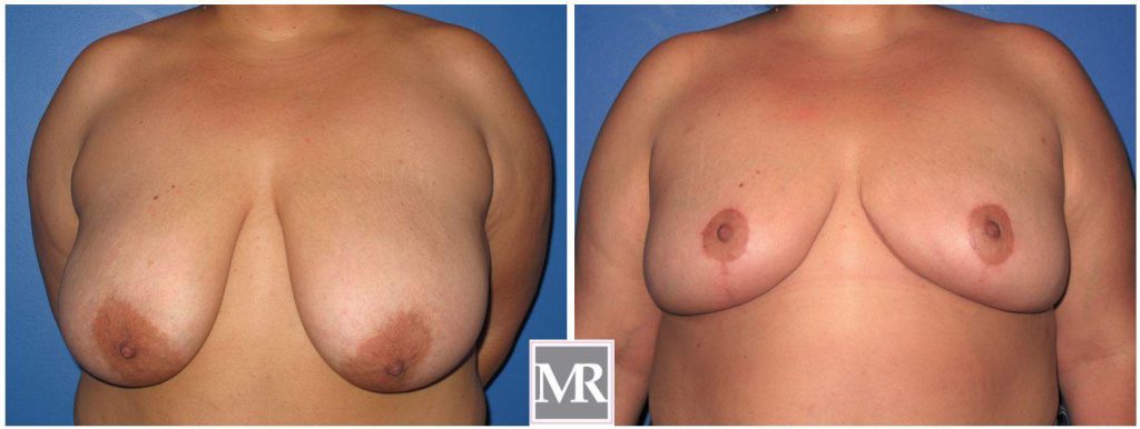Breast Reduction results 90210