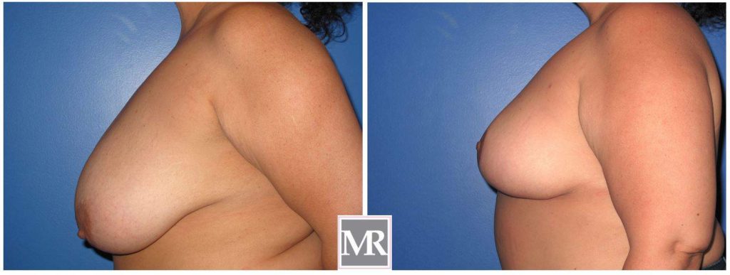 reduce breast size before after pics