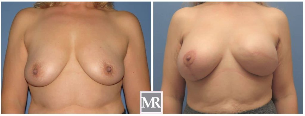 Breast Reconstruction Beverly Hills before and after photos