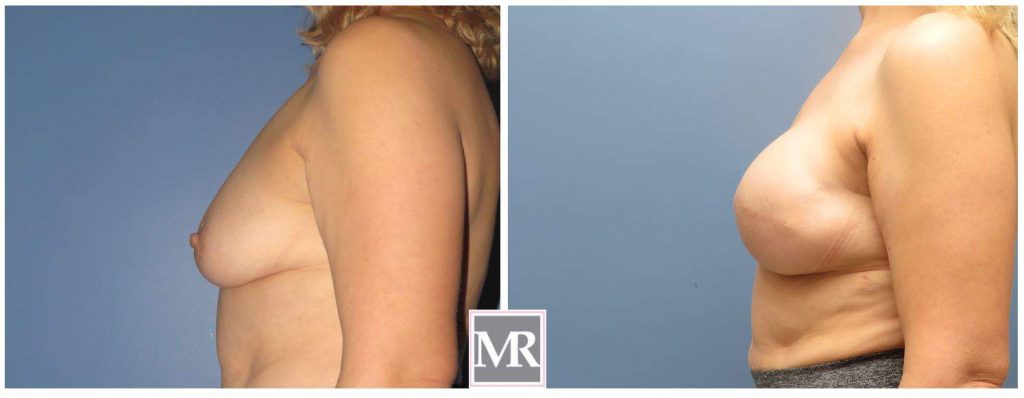Breast Reconstruction Beverly Hills before after results pics