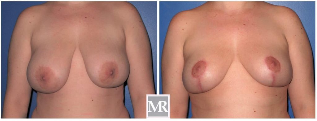 Breast Reduction photo pics Beverly Hills