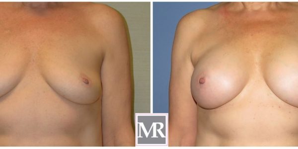 Breast Implants Beverly Hills