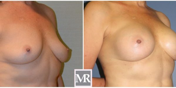 Breast Implants Beverly Hills