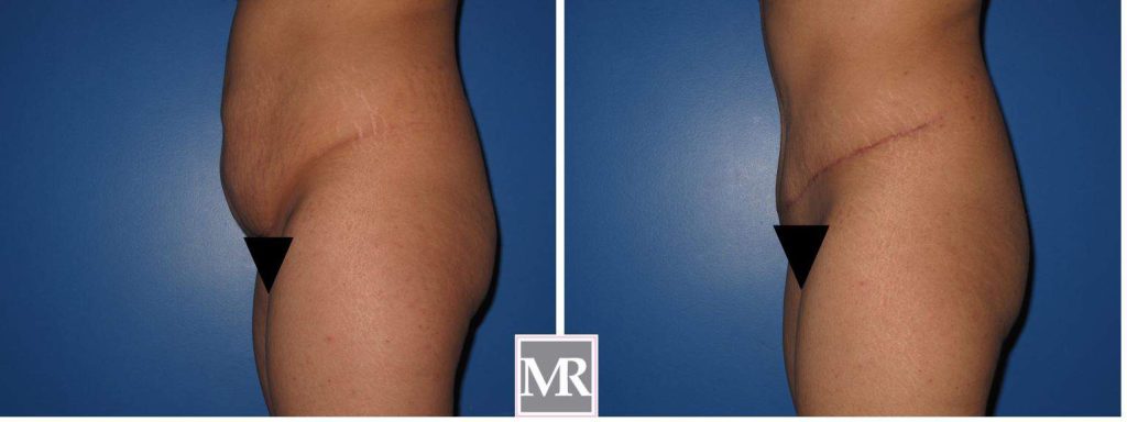 Tummy Tuck results after Beverly Hills