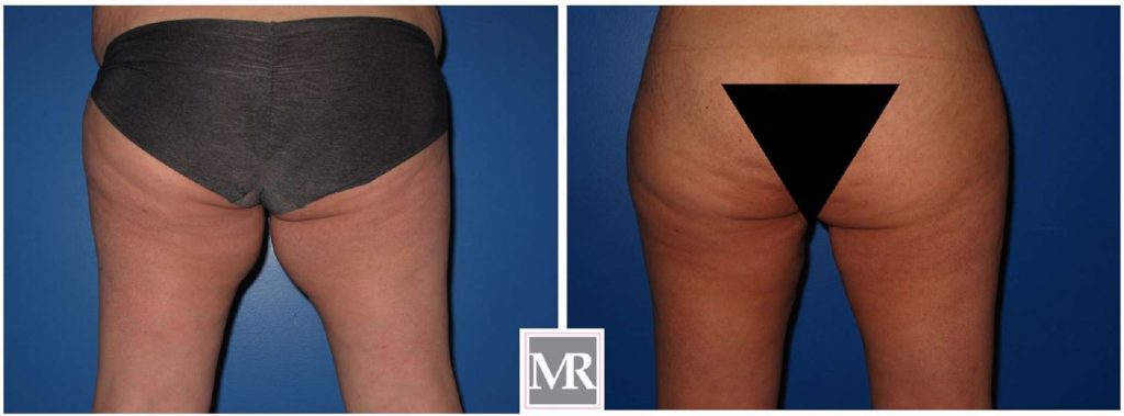Thigh Liposuction Back View before after