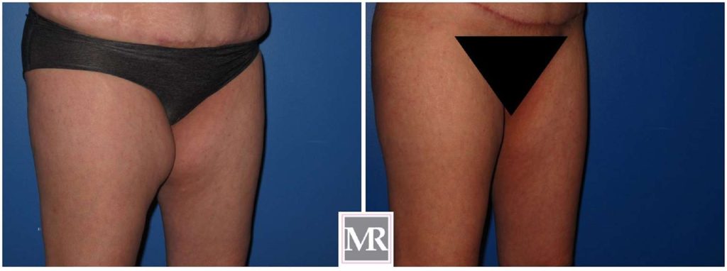 Thigh Liposuction Oblique before after view