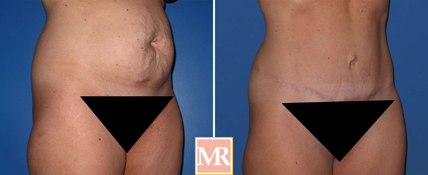 Fleur-de-lis tummy tuck before and afters