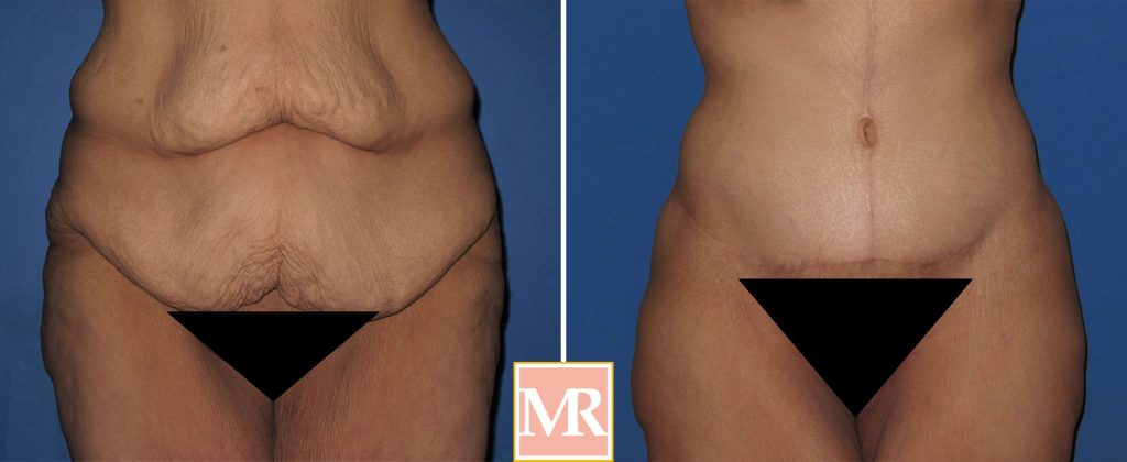 best tummy tuck before and after pics