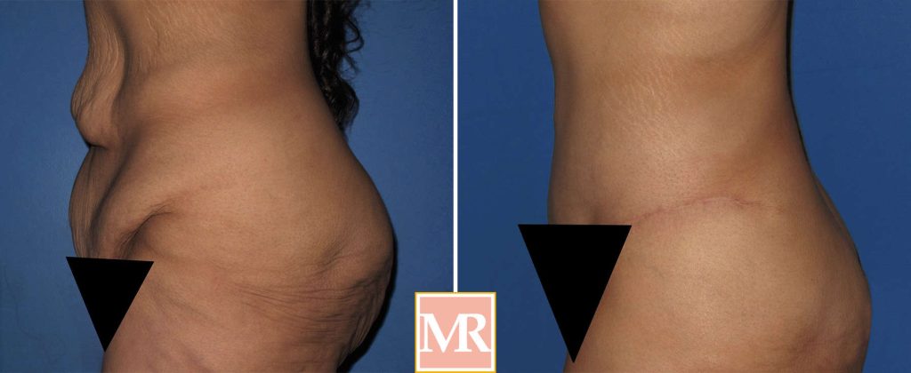 best tummy tuck before and after results