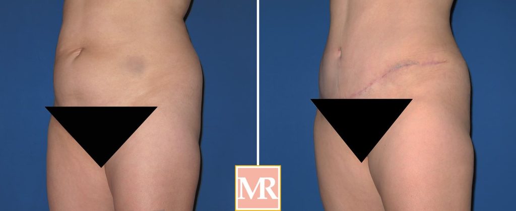 tummy tuck before and after pic results