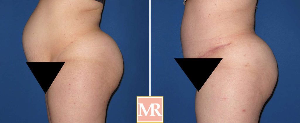 abdominoplasty before and after side view pic