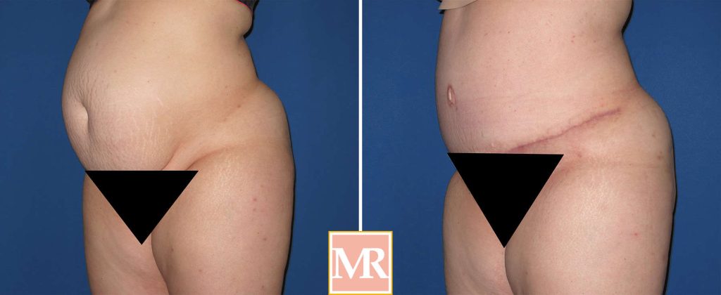 tummy tuck before and after beverly hills pics