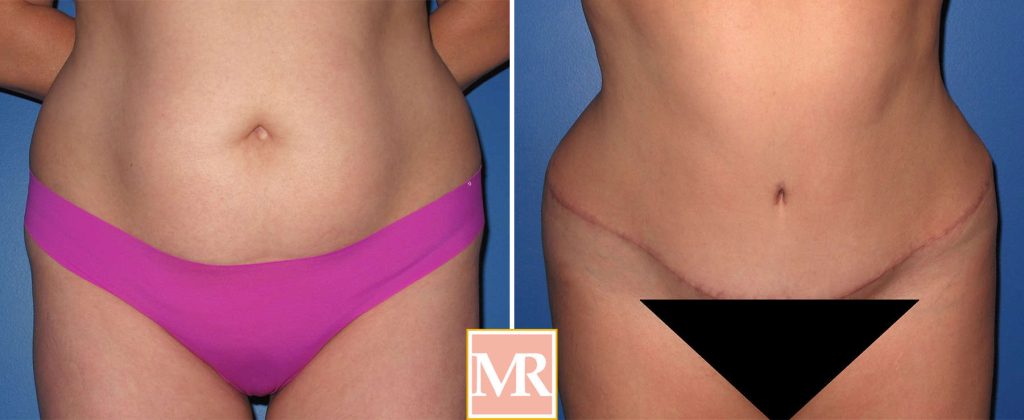 tummy tuck front view before and after pics