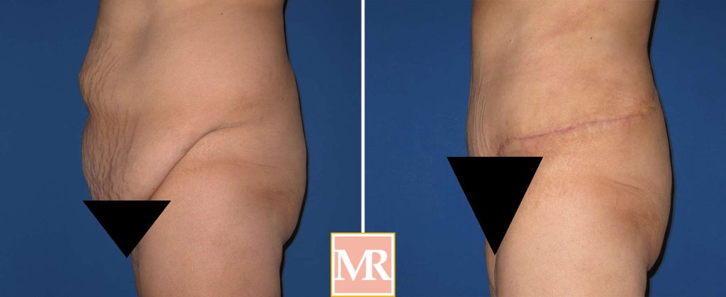 tummy tuck liposuction before after results