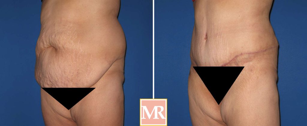 tummy tuck 360 liposuction before and after results