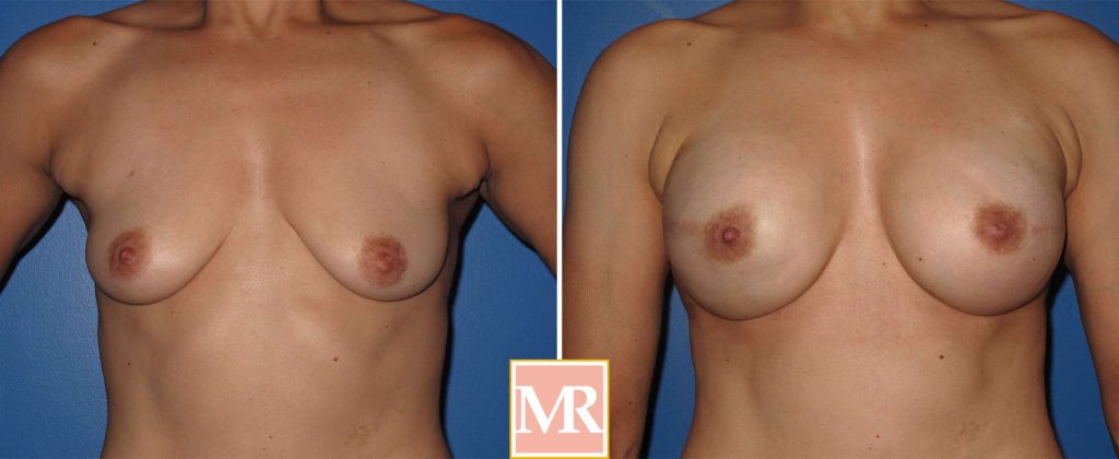 breast reconstruction before and after photo pics