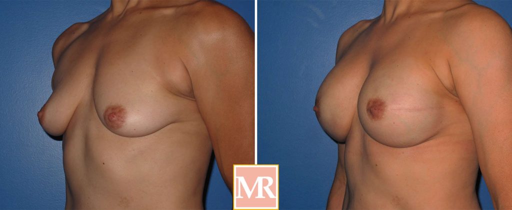 breast reconstruction gallery pics