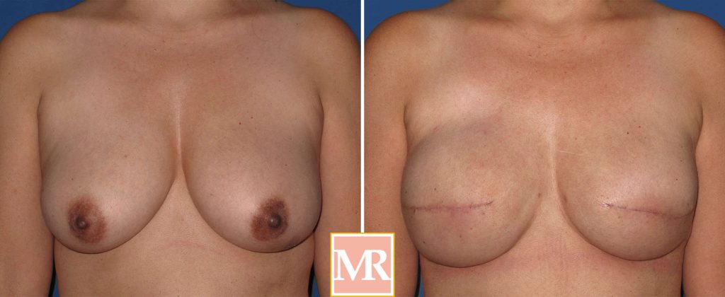 breast reconstruction before after pics