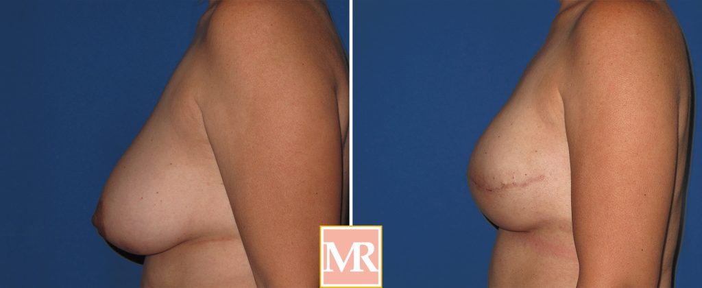 breast reconstruction before and after photo pics