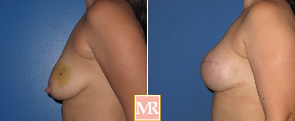 breast reconstruction before and after results