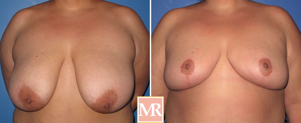 breast reduction photo gallery results