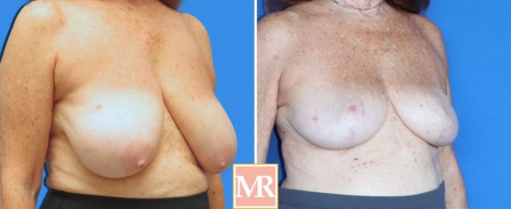 breast reduce before after pics