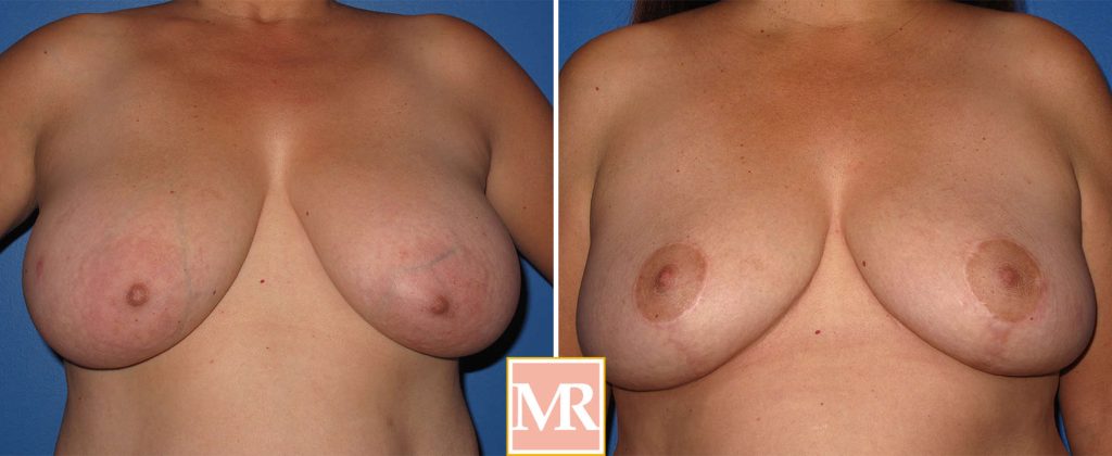 breast reduction before after photo gallery