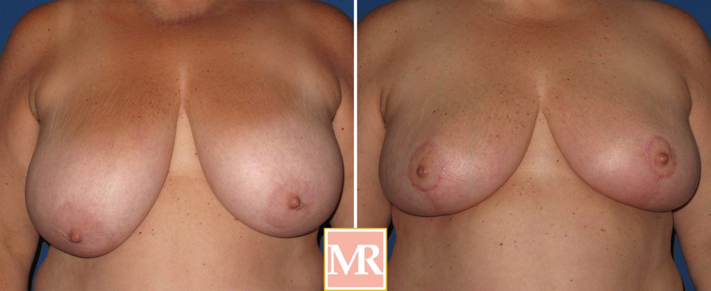 breast reduction before after results photos