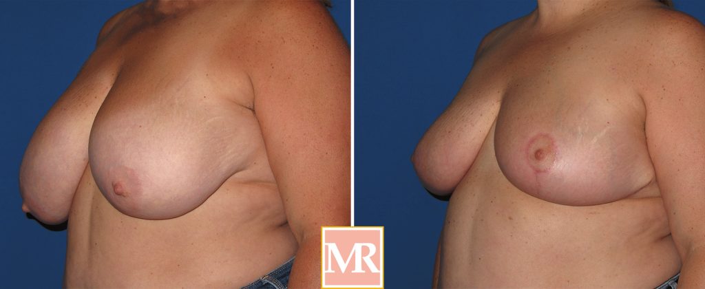 breast reduction before after results