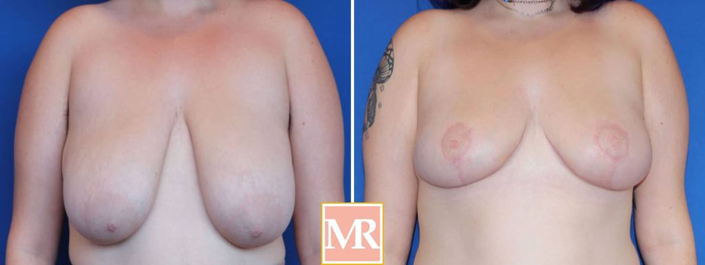 breast reduce before and after