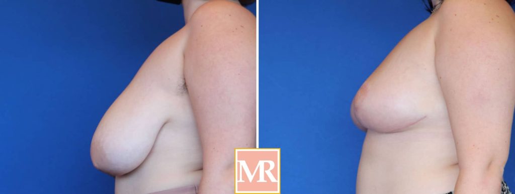 reduce breast lift before and after photos