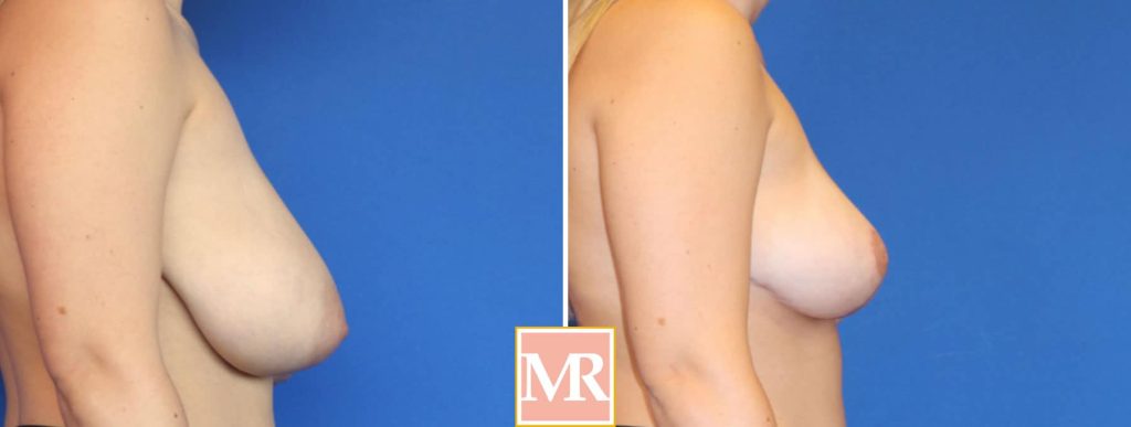 reduce boob size before and after photo