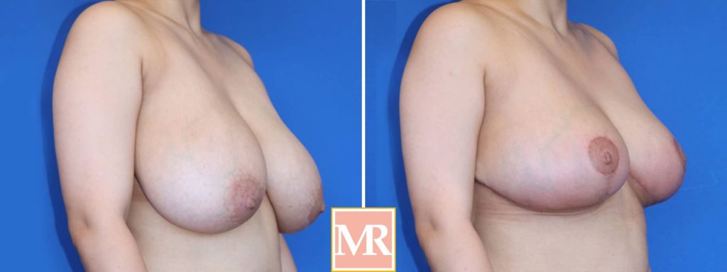 smaller breast surgery before and after pics