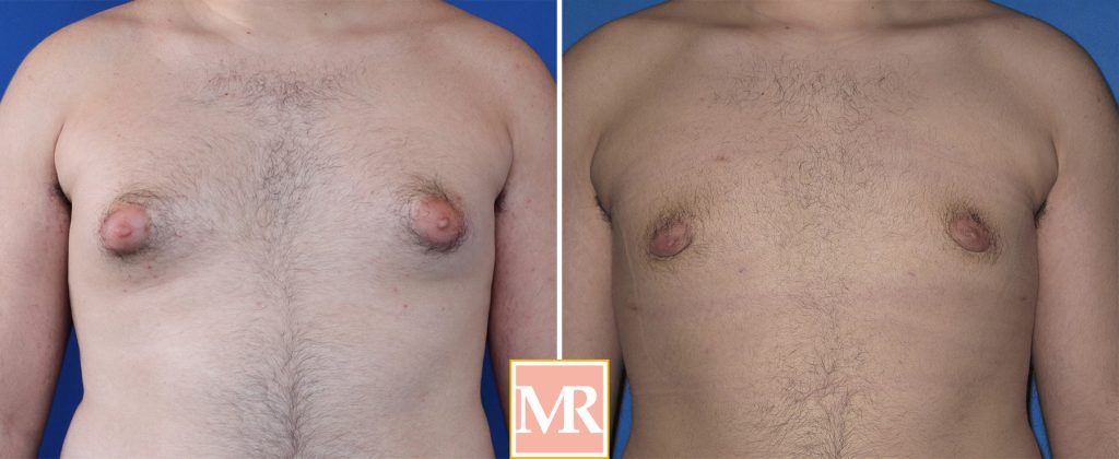 gynecomastia before and after photos