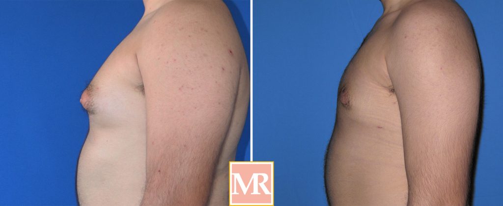 gynecomastia before and after pics