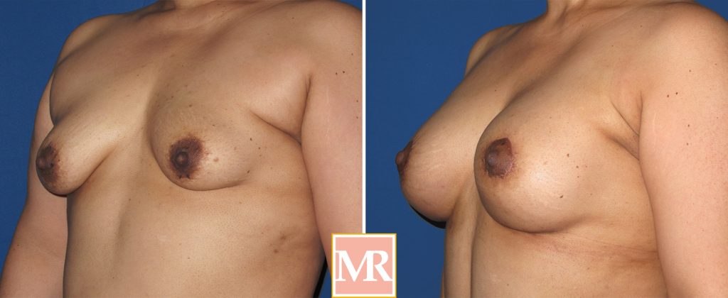 mastopexy breast lift before and after