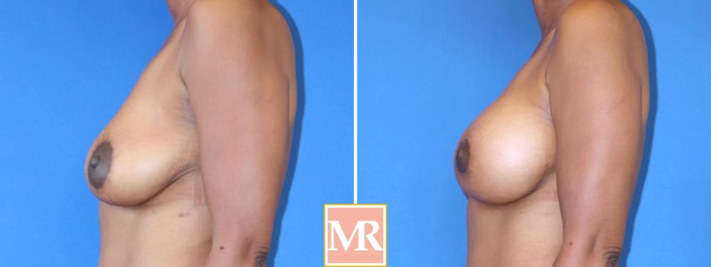 mastopexy augmentation before and after