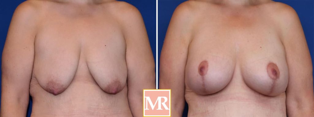 mastopexy before and after results