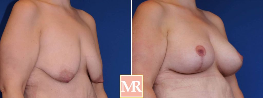mastopexy aug before and after pics