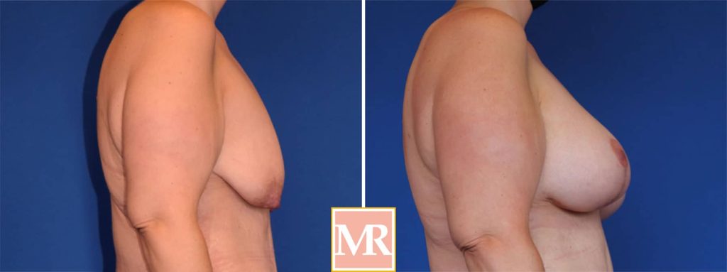best breast lift before and after photos